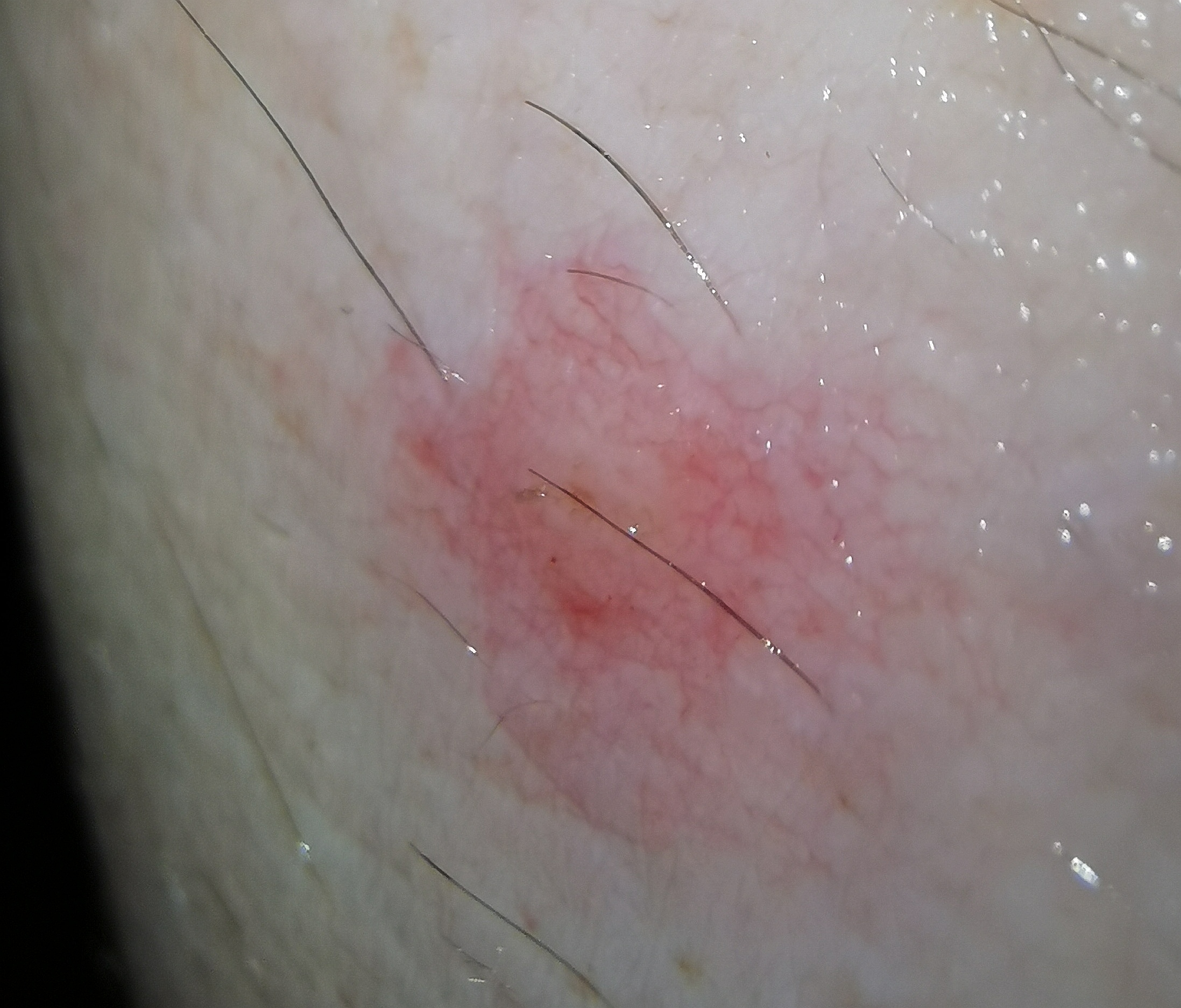 pickel auf dem oberschenkel